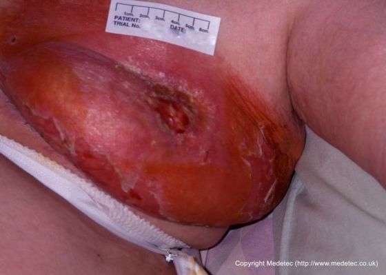 放射性皮炎，乳腺癌治疗
