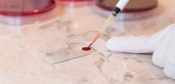 镰状细胞性贫血试验-非典型伤口病原学评估