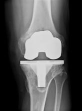 全膝关节置换术伤口愈合